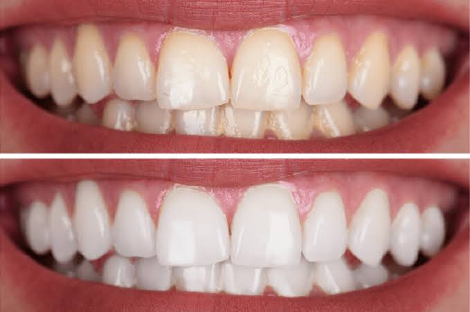Blanqueamiento Dental LED / Láser
