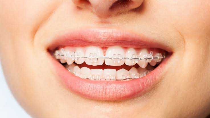 Brackets Estéticos (Zafiro o Cerámica)